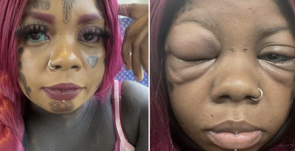 She’s Going Blind After Tattooing Her Eyes, Her Message For Everyone Is….